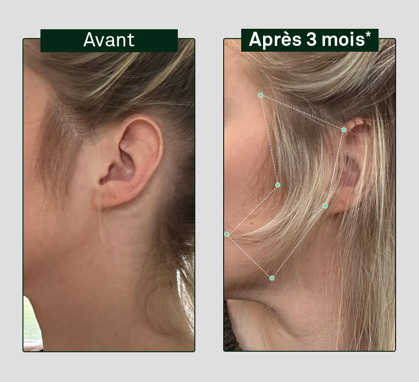 image avant/après